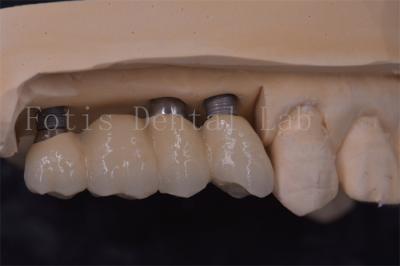 China Coronas de implantes dentales de ajuste preciso Titanio / Zirconia / PFM Restaurar dientes perdidos en venta