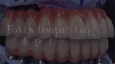 China Serviço OEM Implante Dental Durável Coroa Temporária Fácil Manutenção à venda