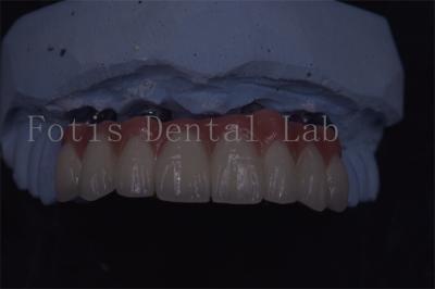 China Precision Crafted Dental Implant Crowns For Superior Longevity And Comfort for sale