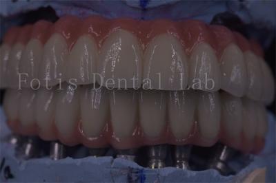China Coronas de implantes dentales de clínicas avanzadas para una funcionalidad superior en venta