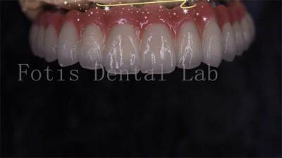 China Modern Seamless Integration Implant Retained Crown Easy To Clean for sale