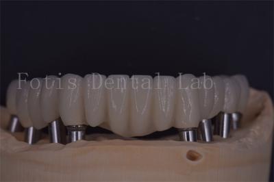 China Coroas de implante dentário confiáveis para conforto e funcionalidade à venda