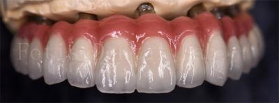 China Coronas de laboratório dentário resistentes à mancha para várias substituições dentárias à venda