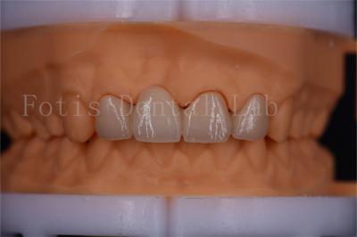 Китай Сертифицированные FDA цифровые короны мостовые зубья дизайн настраиваемый размер продается