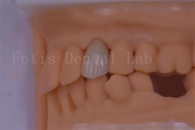 China 3 Shape/Exo Design Digital Dental Crowns Better Fit And Less Discomfort for sale