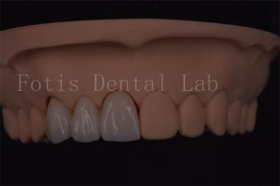 China Coroas dentárias digitais certificadas ISO para implantes dentários de vários tamanhos à venda