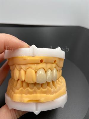 China Coronas digitais de ajuste de precisão, implantes dentários com modo de transmissão de e-mail compatível à venda