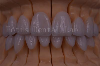 China FDA/ISO/CE Certified Digital Crown Teeth Artificial Crown Any Size for sale