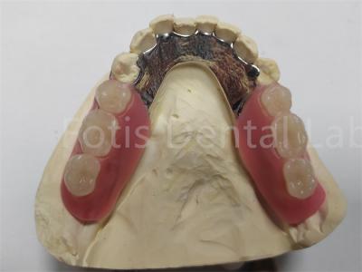 China OEM Flexible Removable Partial Denture  Easy To Clean / Maintain for sale