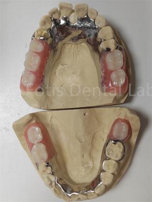 China Customization Temporary Partial Dentures Compatible With Natural Teeth for sale
