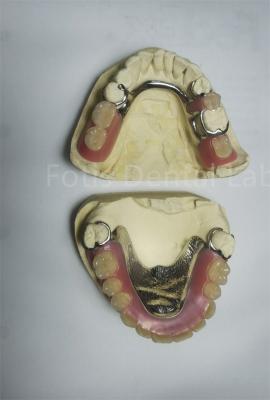 China PEEK Upper Removable Partial Denture Requires Regular Maintenance for sale