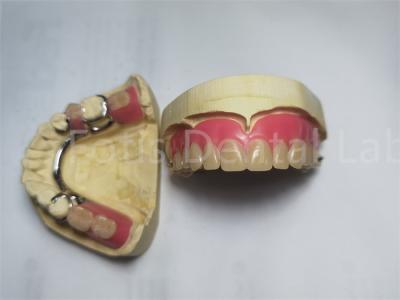 China Comfortable Peek Partial Denture / Removable Dental Prosthesis Customized for sale