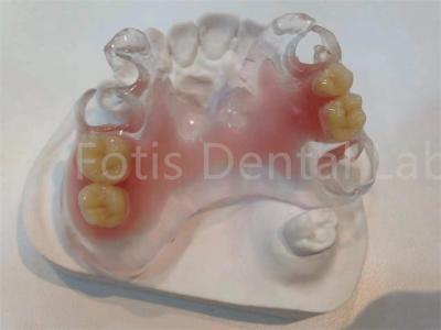 China Prótesis dental TCS Valplast hipoalergénica resistente a manchas para una comodidad duradera en venta