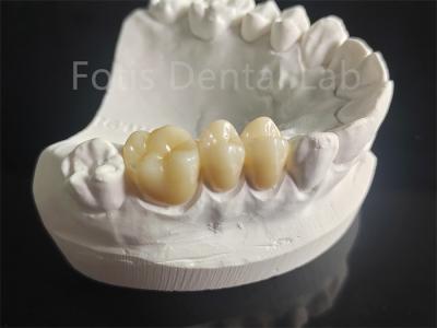 China Wear Resistance Zirconia Layered With Porcelain Dental Material for sale