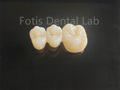 China Circônio em camadas de porcelana de alta resistência para pontes dentárias duradouras à venda