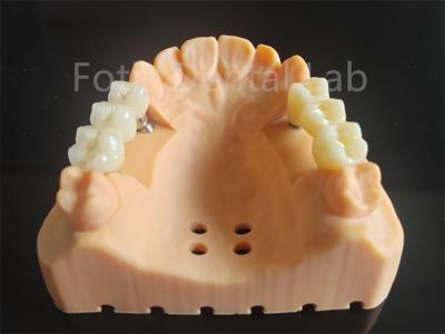 China Customized Full Contour Zirconia Layered With Porcelain Dental Material for sale
