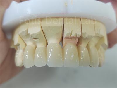 Chine Produits dentaires en zirconium recouvert de porcelaine Facile à entretenir à vendre
