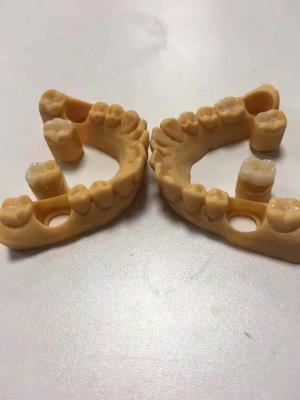 China Trustworthy Precise Dental Ceramic Inlays And Onlays Customizable for sale