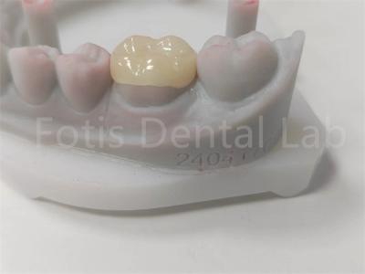 China OEM Dental Inlay y Onlay Restauración de cerámica y relleno de color dental en venta