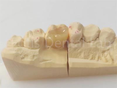 China Inlay e Onlay dentários de precisão para restaurações precisas e duradouras à venda