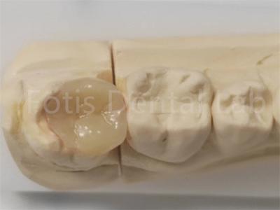 China Aesthetic Inlay And Onlay In Dentistry For Indirect Filling And Tooth Restoration for sale