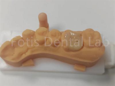 China Dental Restorations Ceramic Inlay And Onlay For Long Lasting for sale