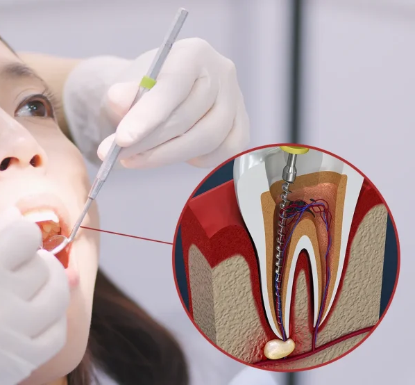 Dental Premixed Calcium Hydroxide Paste with Iodoform product packaging and syringe