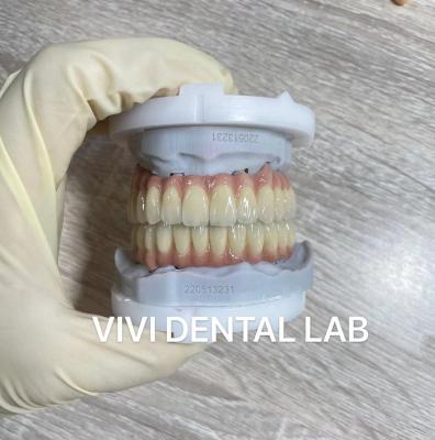 China Coronas dentales digitales de boca llena y puente de PFM translúcido en venta