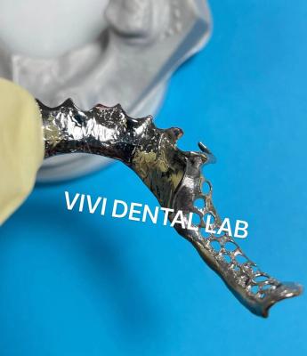 China Dental Dentures Metal Framework SLM Ni Be free CoCr Partial Denture for sale