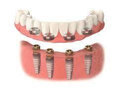 China VIVI Sheftner Ivoclar Implant Supported Dentures With Locators for sale