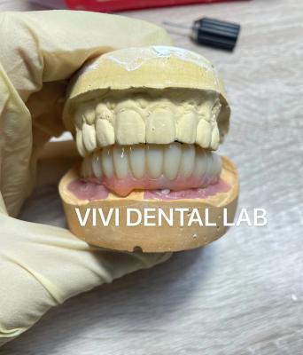 China Tooth Temporary Dental Implant Crown PMMA Biocompatible Ni Be Free for sale