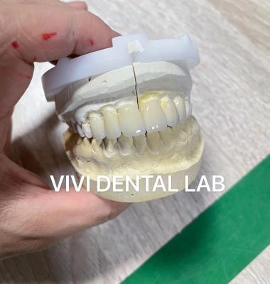 China Wafer Thin Dental Emax Laminate Veneers Translucency Porcelain for sale