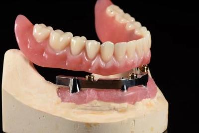 China Titanium Implant Supported Dentures Precise Ivoclar Denture Over Implants for sale