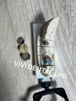 China VIVI Post Core And Crown Ni Be Free dental restoration for sale