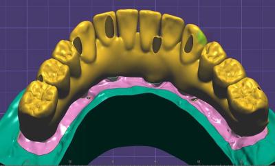 China Professional Dental Crown Design Implants And Bridges 3 Shape Exocad for sale