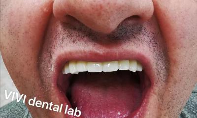 Cina Dental Digital Full Zirconia Bridge In Mouth Stabile professionale in vendita