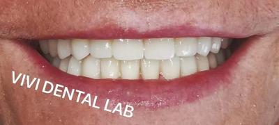 China Puente dental ISO de boca llena Puente de dientes de zircónia de múltiples capas en venta