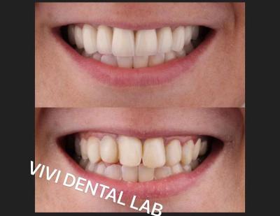China NI Ser gratis coronas dentales en la boca profesional certificado por la FDA en venta
