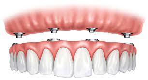 China All On Four Ivoclar Implant Supported Dentures Retentive Natrual Looking for sale