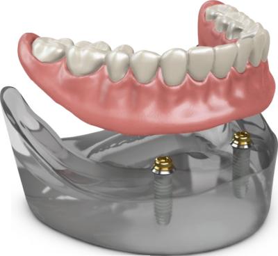 China Dentes implantes com aparência natural à venda
