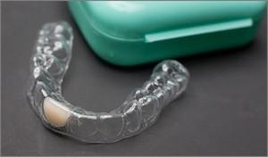 Chine Retenant dentaire stable Orthodontique professionnel Retenant Essix clair à vendre