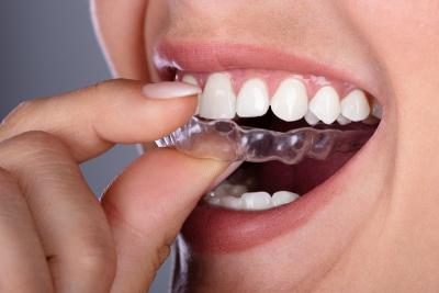 China Stabile Zahnausrichtung Korrektur Zahnreiniger Zahnausrichtung zu verkaufen