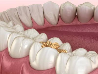 China Gold Inlay Onlay Dental Crown High Noble Yellow Ni Be Free for sale