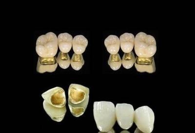China High Nobel Yellow Gold Crown Be Nickel Free PFM Tooth Crown for sale