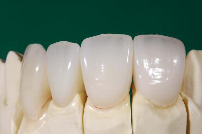 Chine Laboratoire dentaire de la Chine d'IPS EMax de couronne de lithium de couronne professionnelle dentaire de Disilicate à vendre