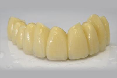 China Dental PMMA Provisional Crown Translucency Esthetic IPS E Max Crown for sale