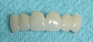 China Emergency Temporary Dental Crown Implant Replacement Professional PMMA for sale