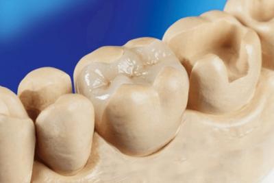 China Porcelana Dental Inlay Onlay Zirconia Emax Alta Estética FDA aprovado à venda