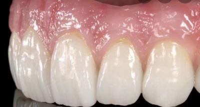 China Coroas de laboratório dentário estético à venda