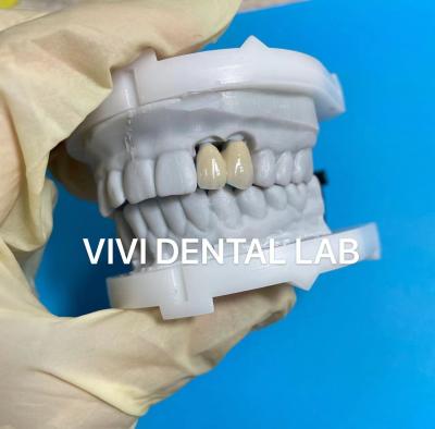 China Ni Be Free Digital Dental Crowns Accurate Metal Ceramic Crowns for sale